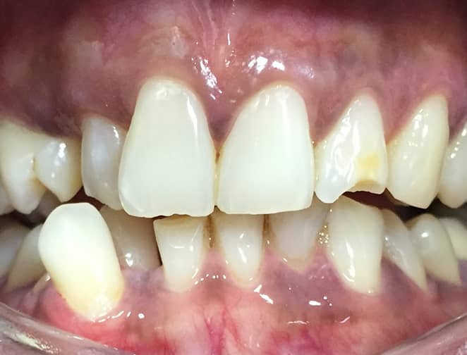 Before - Smile 360